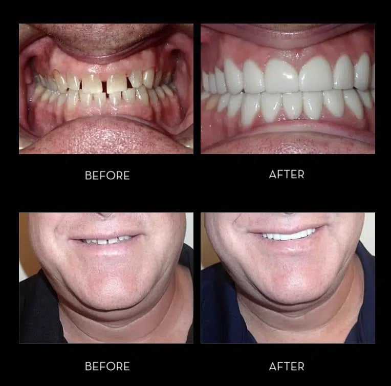 TMJ Before and After