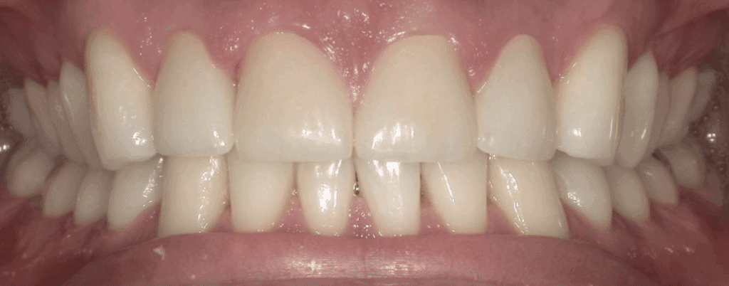Case Study: Affordable Dental Crowns for Gaps and Discoloration (AFTER)