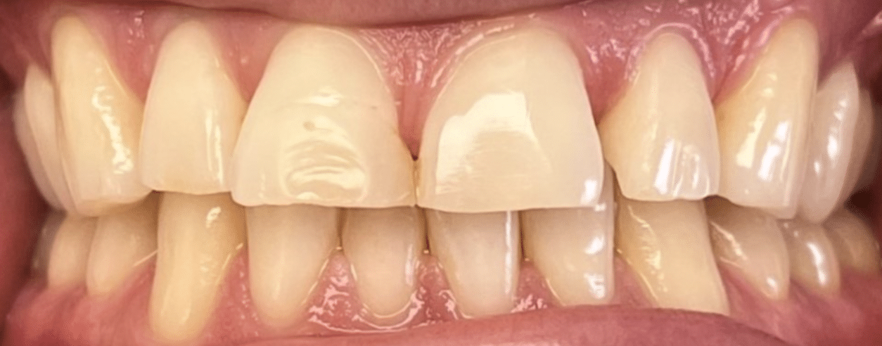 Case Study: Affordable Dental Crowns for Gaps and Discoloration (BEFORE)