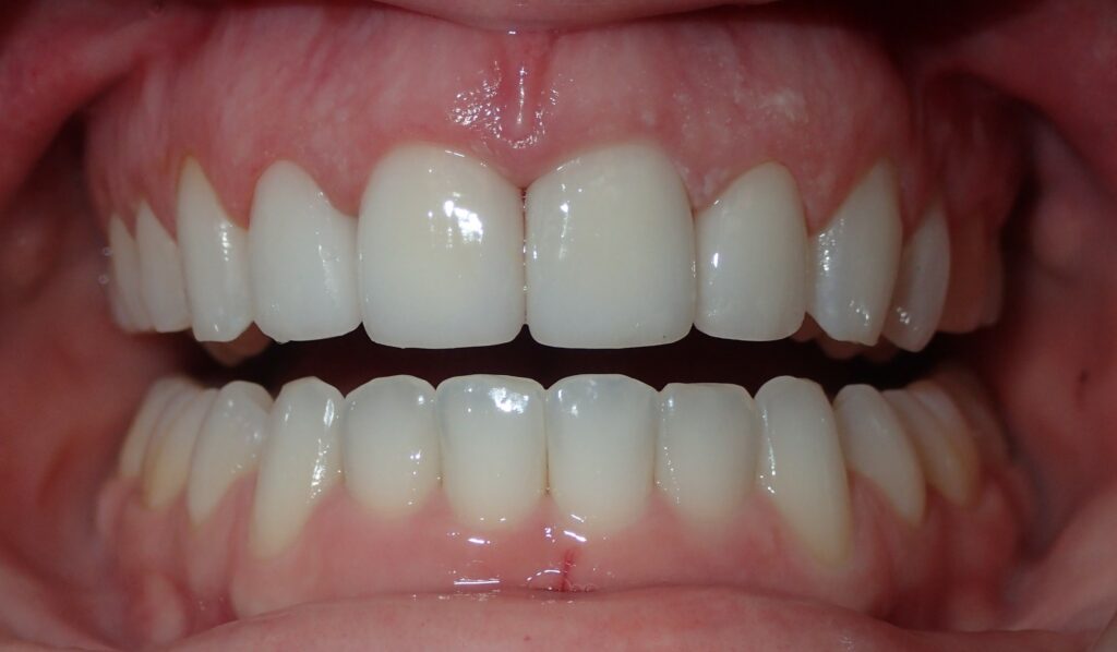 Affordable Veneers After Discoloration