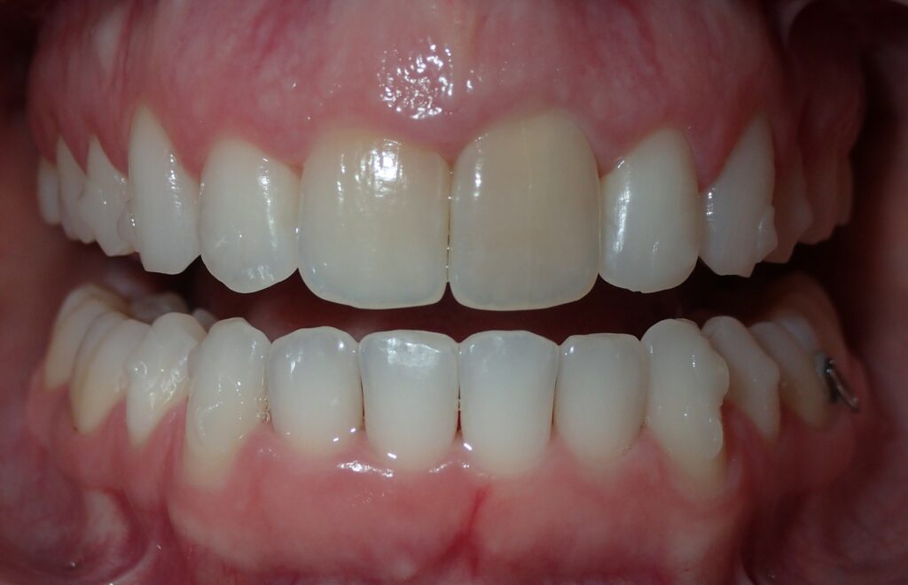 Affordable Veneers Before Discoloration