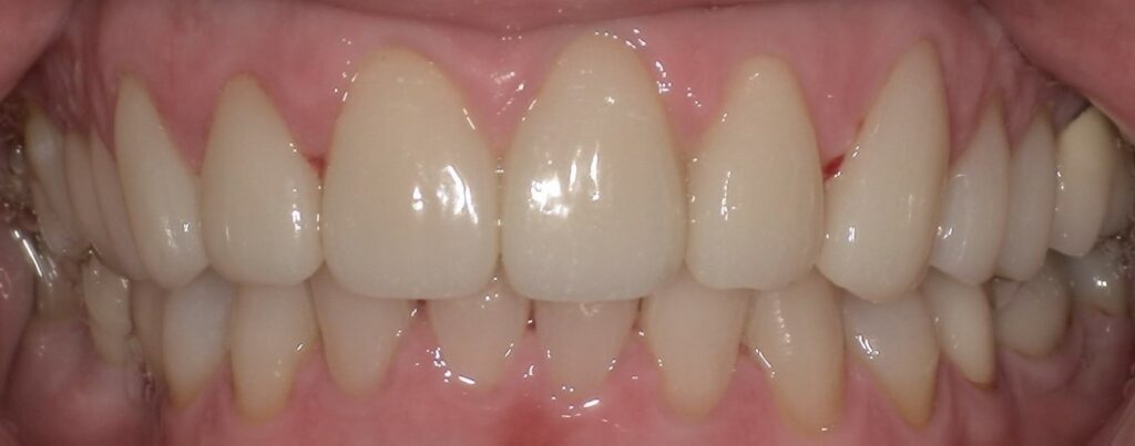 Crowns Dental Bonding After