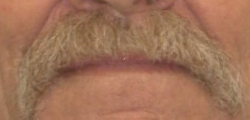 Snap-In Overdentures Before