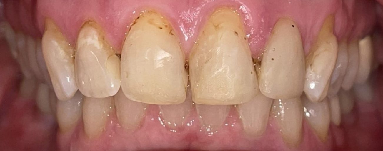 Crowns Dental Bonding Before