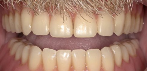 Snap-In Overdentures After